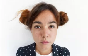 Penyebab Jerawat Dan Tips Ampuh Mengatasi Jerawat Untuk Remaja