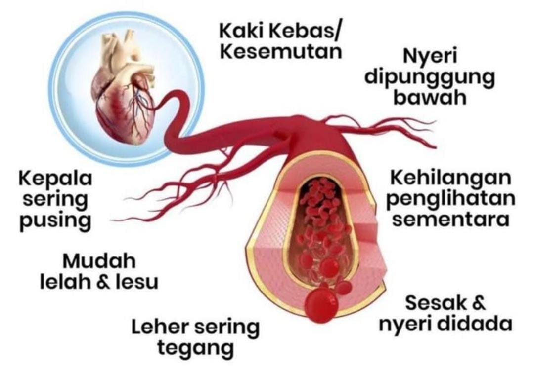 Waspadai untuk Hidup Lebih Sehat, Ini Penyebab dan Faktor Risiko Pembuluh Darah Tersumbat