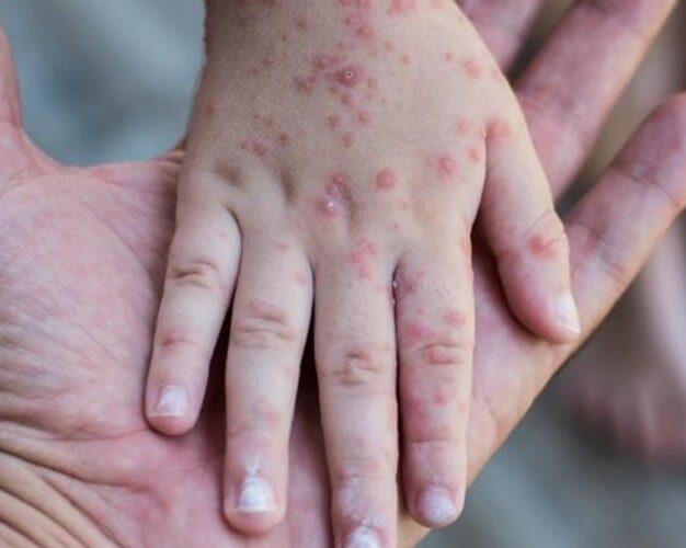 Waspada Penularan Campak, Ini Strategi Aman Saat Beraktivitas di Luar